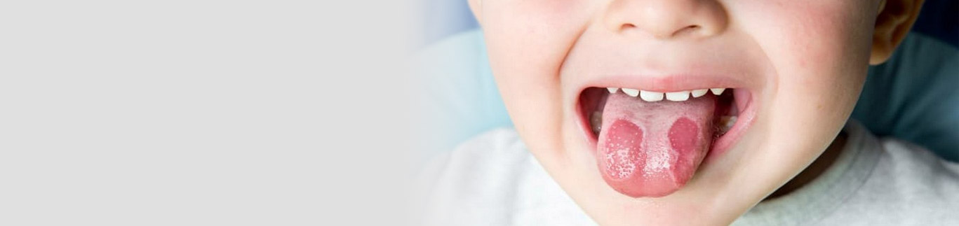 Стоматит у дітей – чому виникає і як його лікувати?