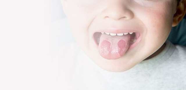 Стоматит у дітей – чому виникає і як його лікувати?